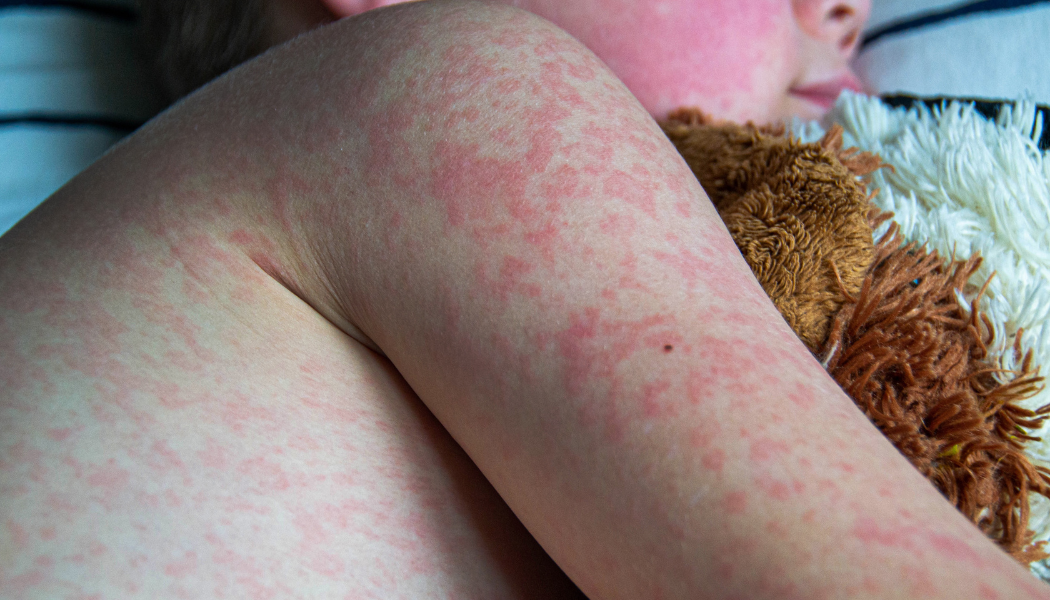 Sarampo em alta! Especialistas alertam para risco de reintrodução da doença e reforçam a importância da vacinação